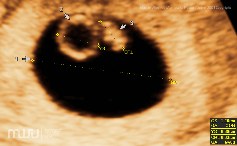 Wczesna ultrasonografia ciążowa